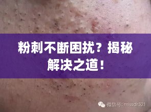 粉刺不断困扰？揭秘解决之道！