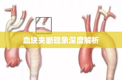 血块夹断现象深度解析