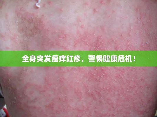 全身突发瘙痒红疹，警惕健康危机！